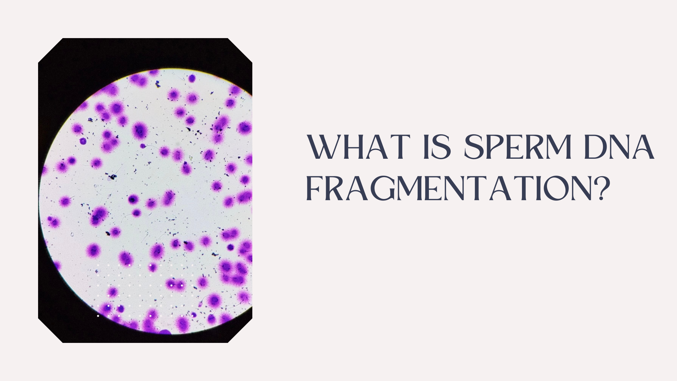 What Does Sperm DNA Fragmentation Mean?