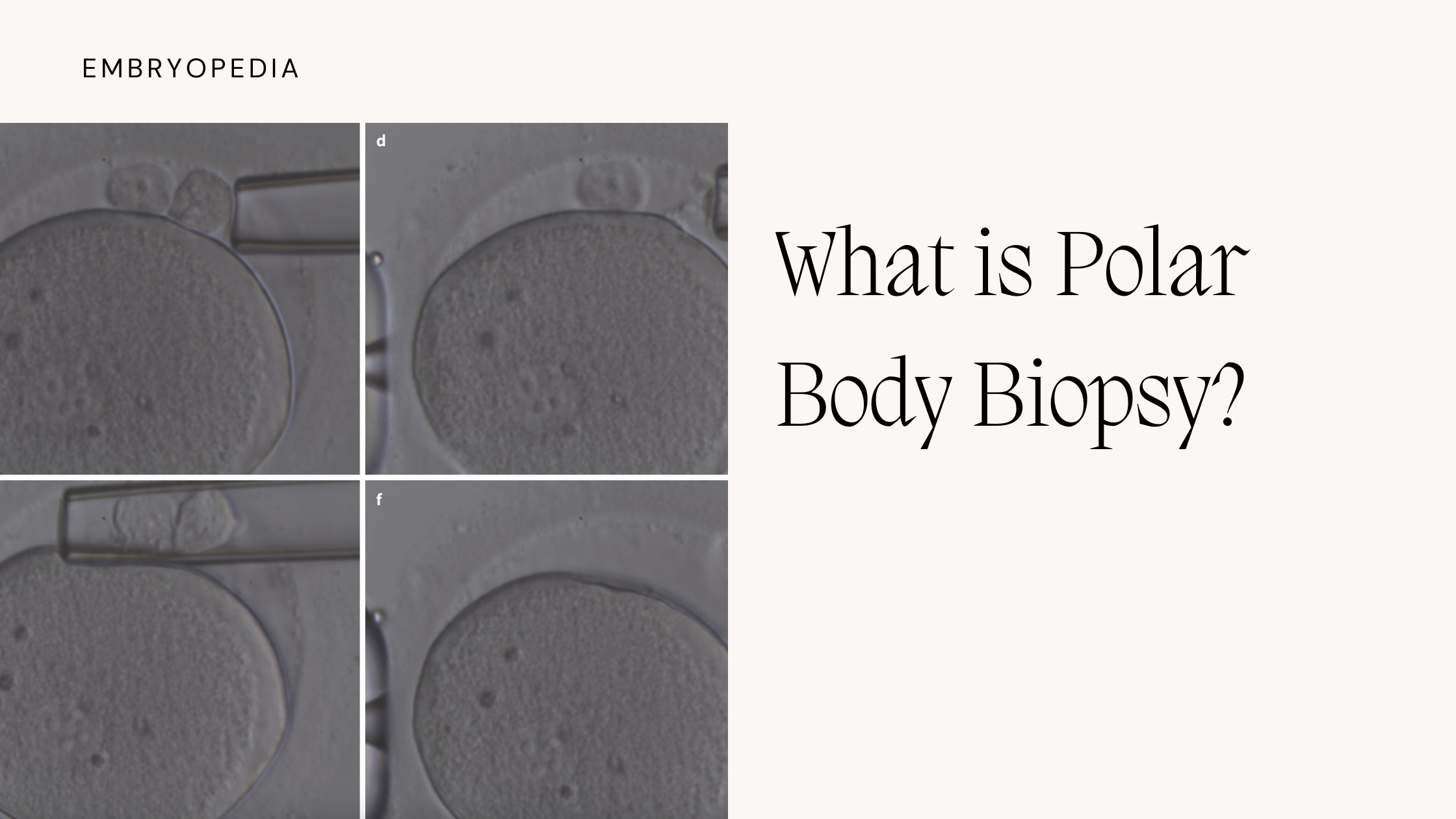 What is Polar Body Biopsy and How is It Done?